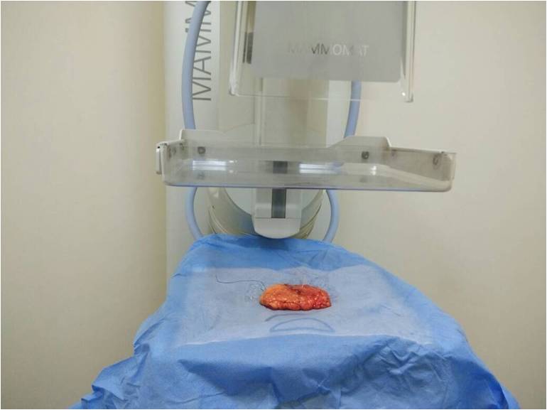 WIRE LOCALIZATION OF NON PALPABLE BREAST LESIONS Dr. Ashish Goel